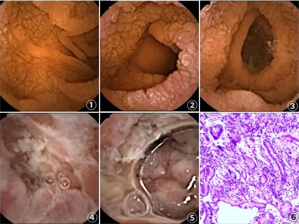 吃面食就拉肚子？你可能得了乳糜泻